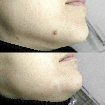 Before and after the application of the Skincell Pro