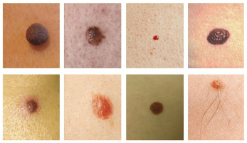 The most common spots on skin – is a birthmark, and papilloma (warts)