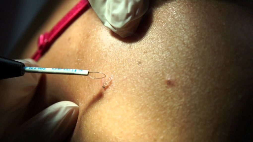 removal of radio waves of papilloma