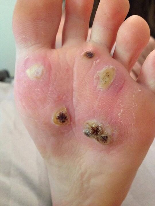 plant warts on the foot