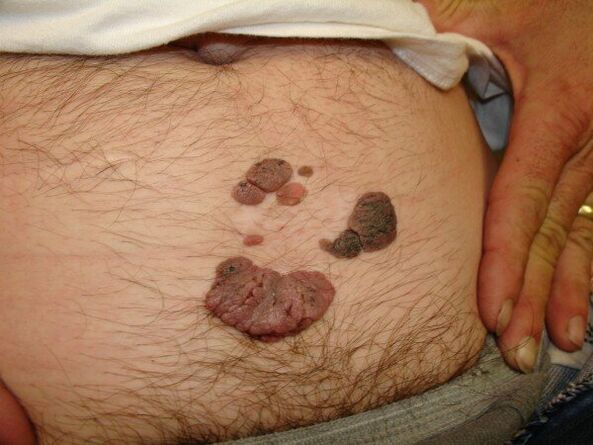 Papillomas on the stomach of a man