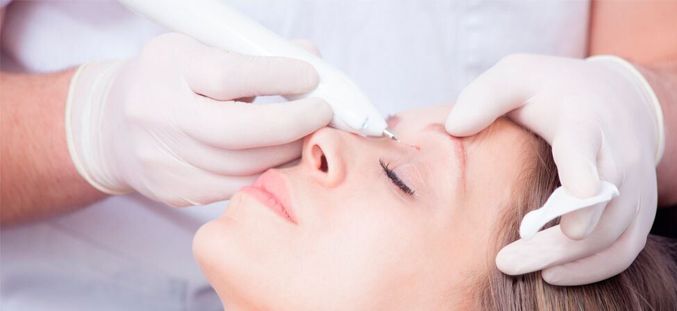 Procedure for removing laser facial warts